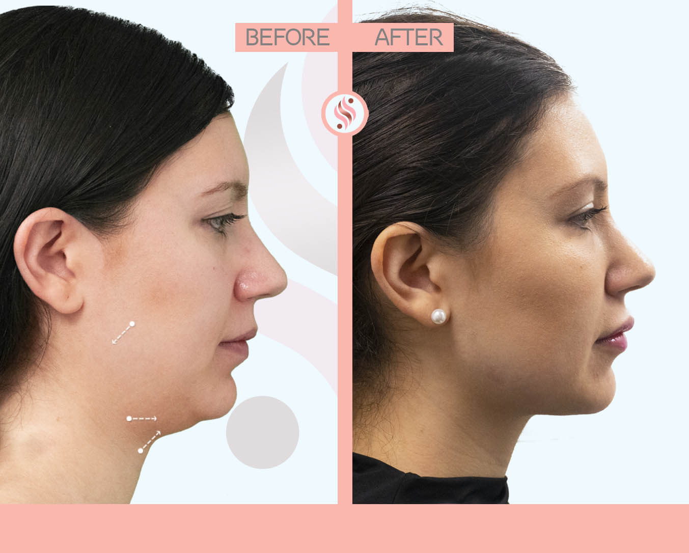 Jawline, Double Chin treatment