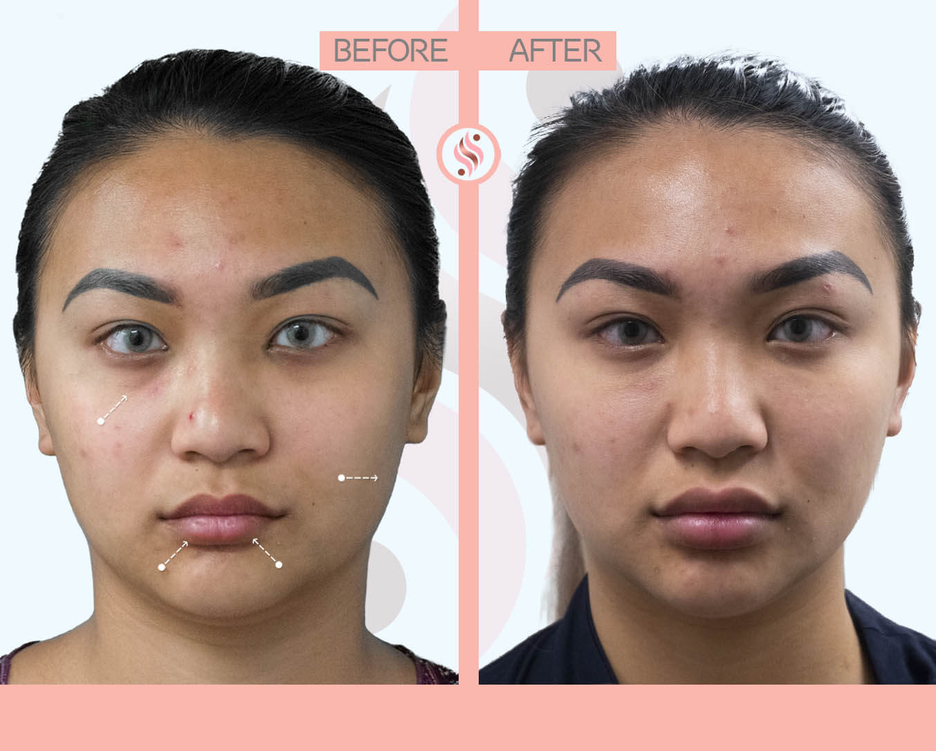 Tear trough, lips, massesters injection nyc - before and after