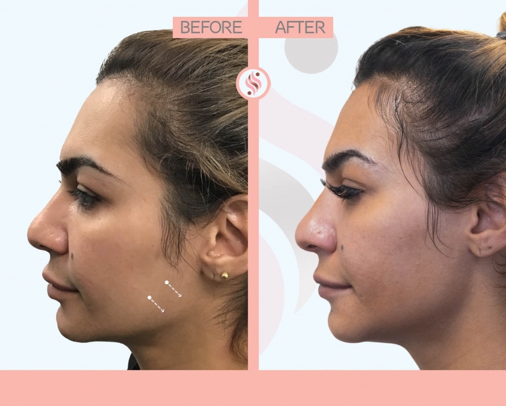 NF jawline contouring