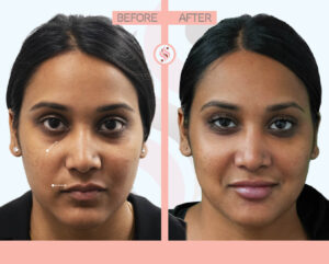 tear trough and lips injection nyc - before and after photo