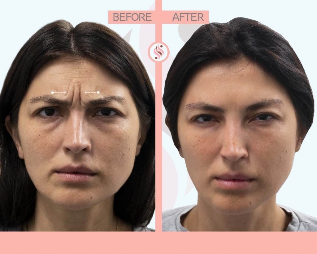 botox injection before after