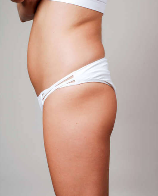 Sculptra Butt Lift before Sculptra Butt Lift before