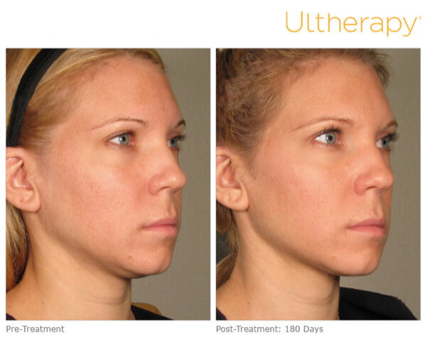 Ultherapy before after