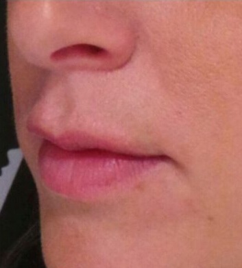 hyaluronidase lips after hyaluronidase lips after
