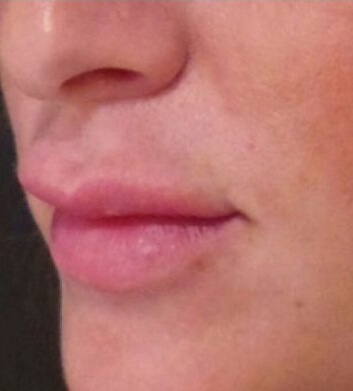 hyaluronidase lips before hyaluronidase lips before