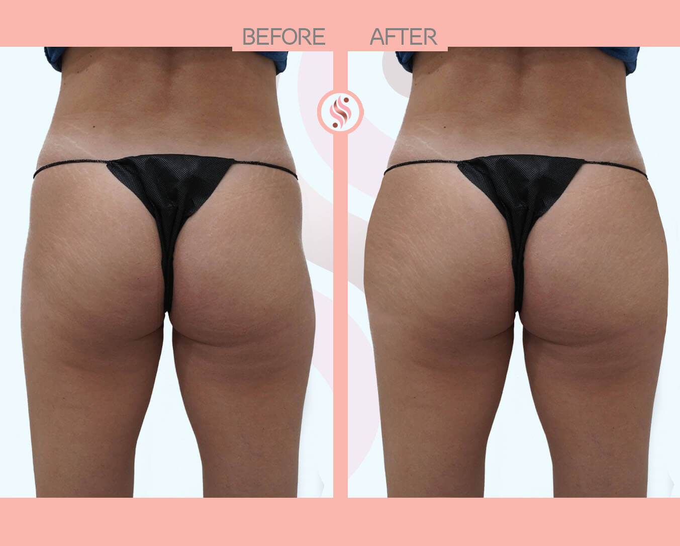 Butt Lift