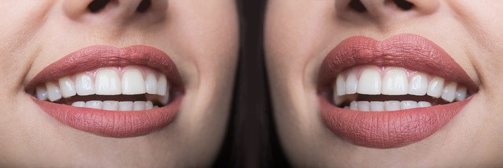 Botox lip flip - before and after
