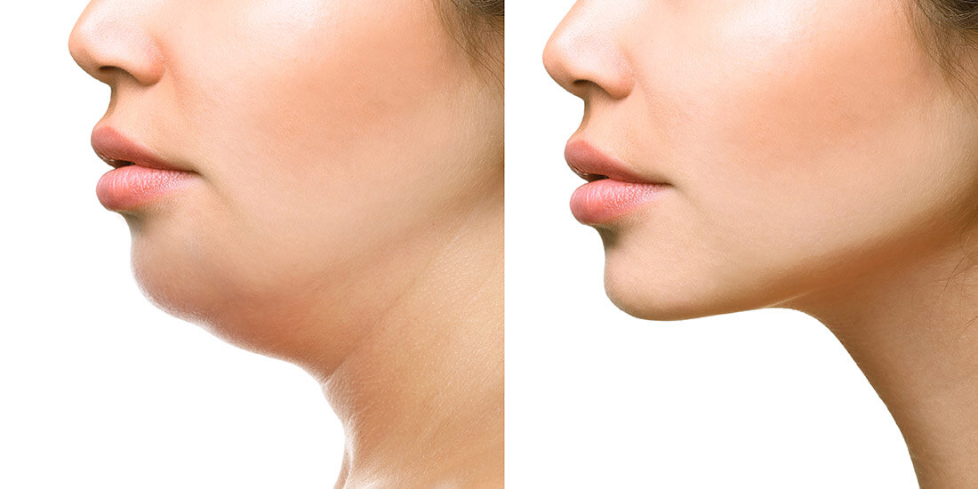 Kybella double chin removal before and after