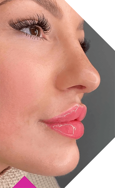 Russian Lip Filler Technique Skinly Aesthetics