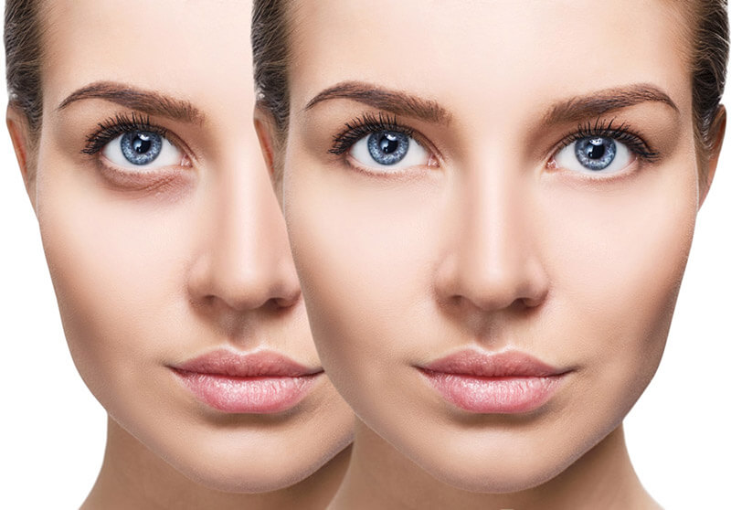 Under eye filler