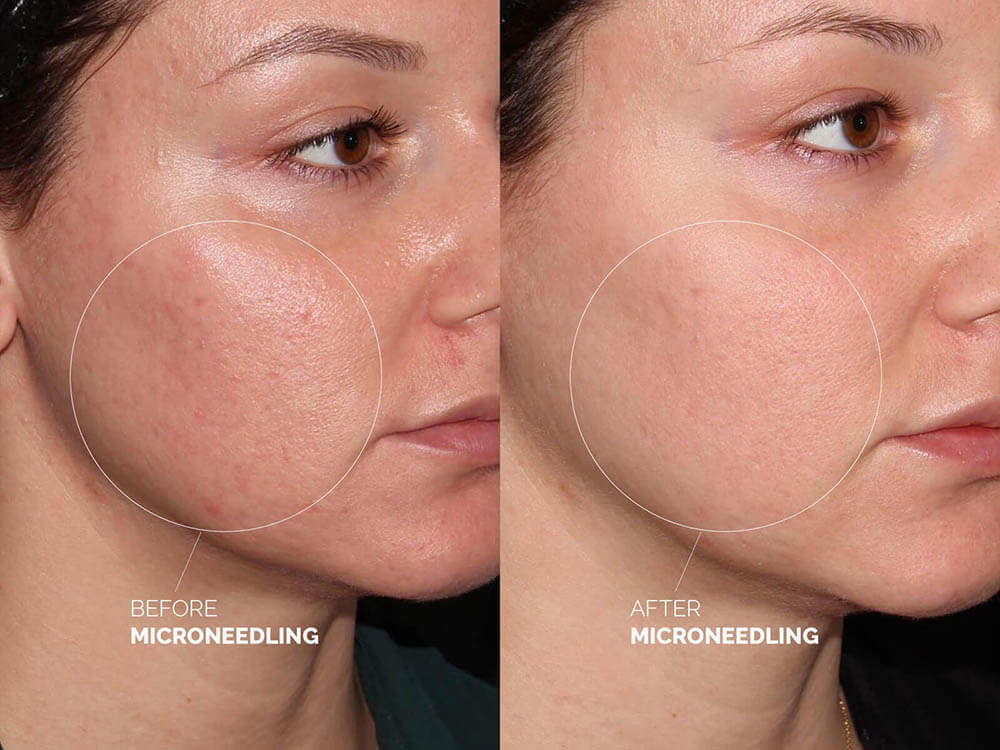 Microneedling treatment before and after 4 sessions