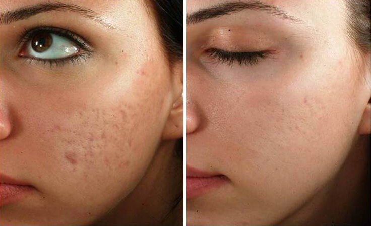 How Much is a Microneedling Session?  