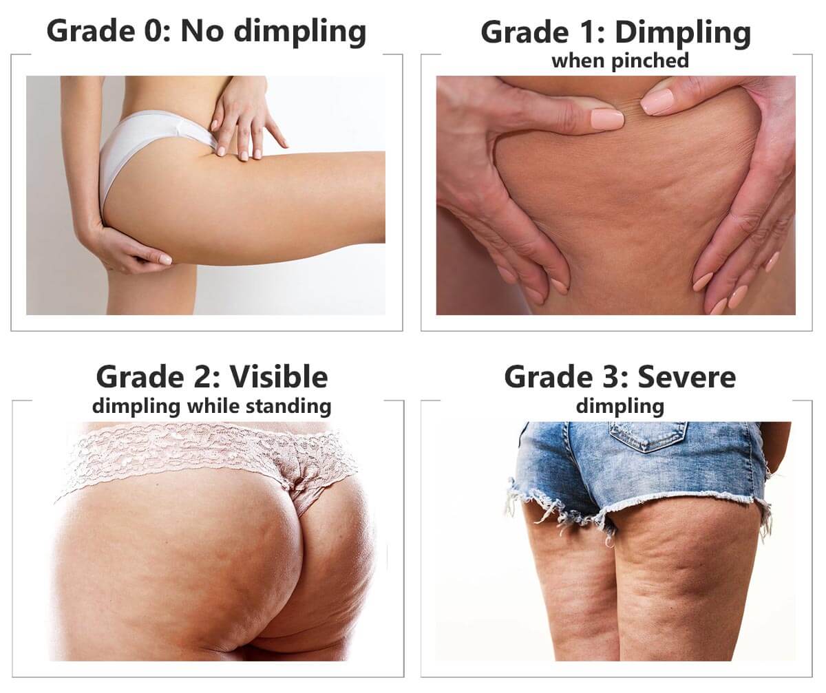Cellulite classified dimpling grade