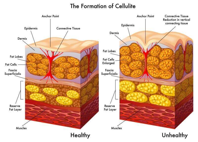 Cellulite symptoms causes