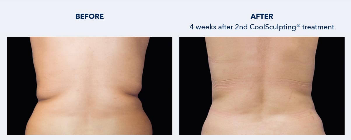 CoolSculpting for Bra Fat reduction