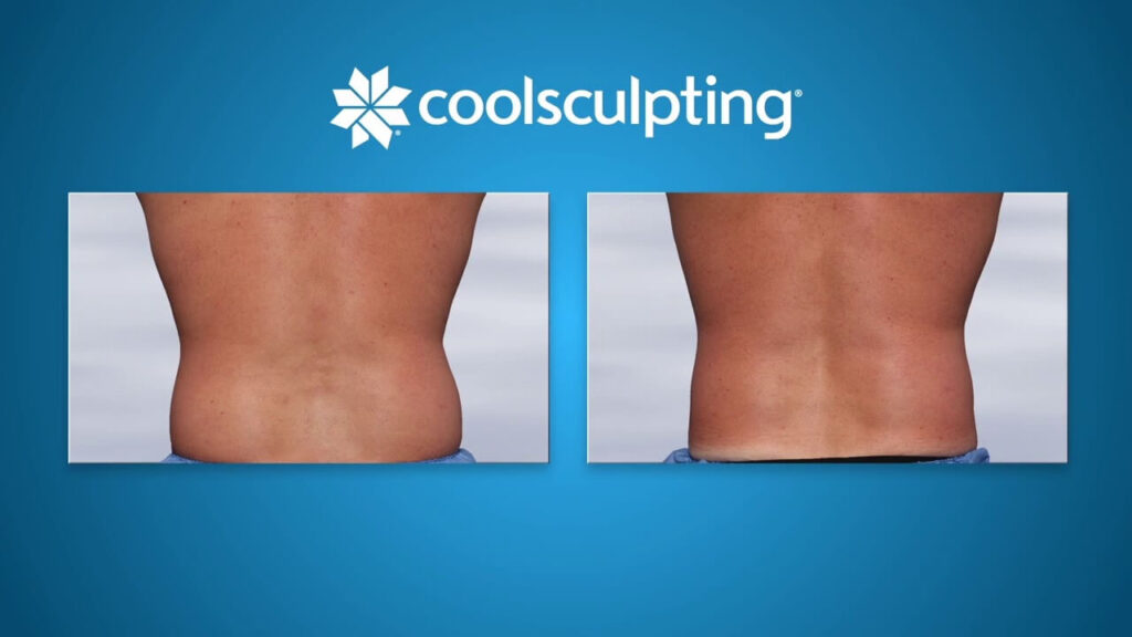 CoolSculpting for back fat reduction