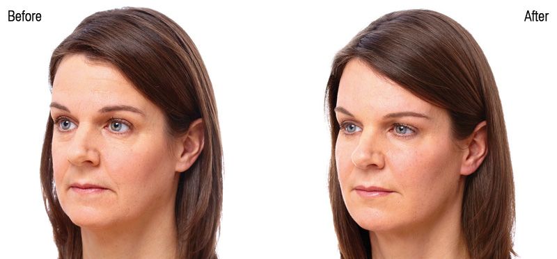 Juvederm Voluma before and after