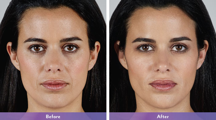Juvederm ultra before and after