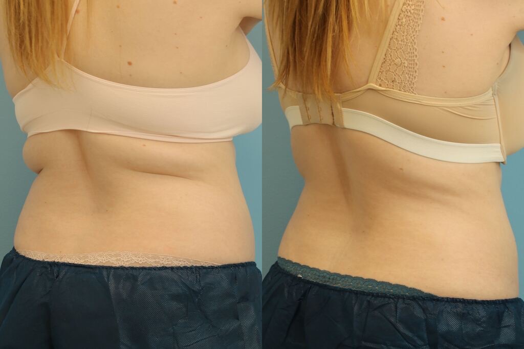 coolsculpting for bra fat reduction