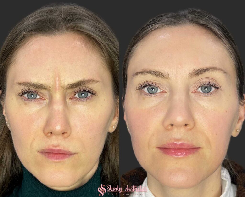 31 year old patient demonstrating complete resolution of frown lines between the eyebrows after administration of 20 units of botox