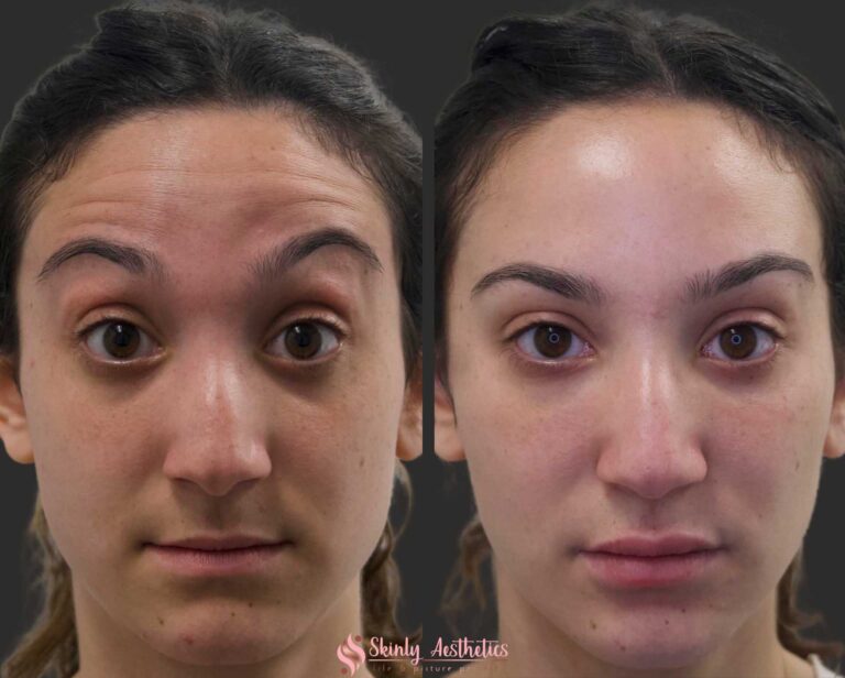 Botox injections to reduce the appearance of horizontal forehead wrinkles