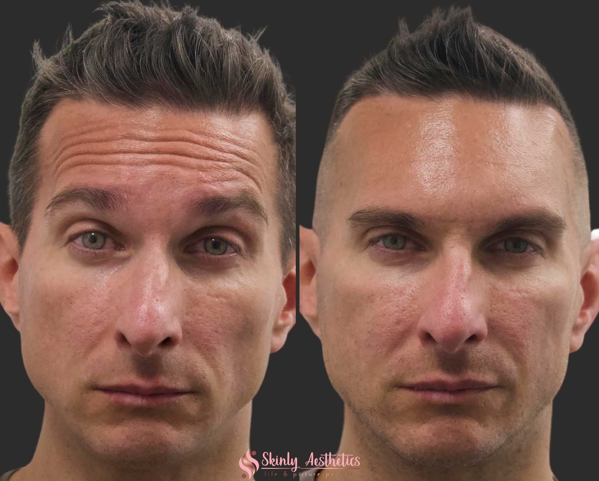 before and after botox forehead wrinkles in a male patient