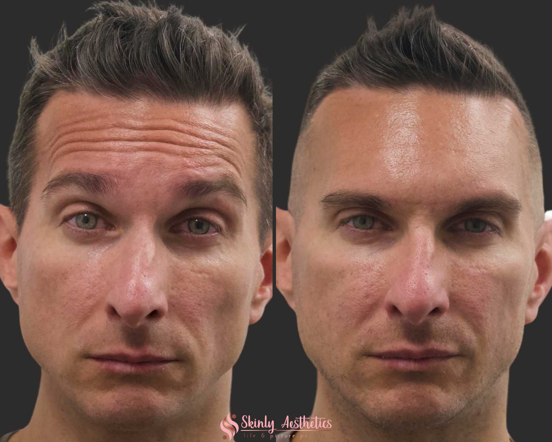 Botox Before And After Results Everything You Need To See Know