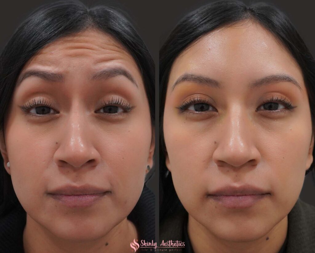 before and after results following completion of Botox treatment for forehead wrinkles