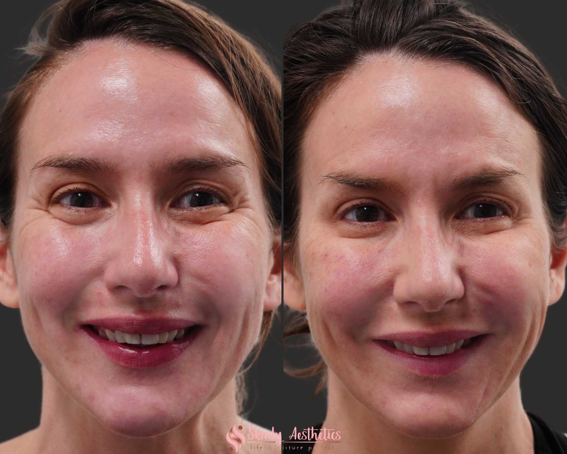 Botox crows feet before and after results