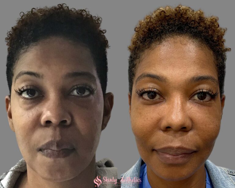 before and after results following under eye bag treatment with Juvederm Voluma