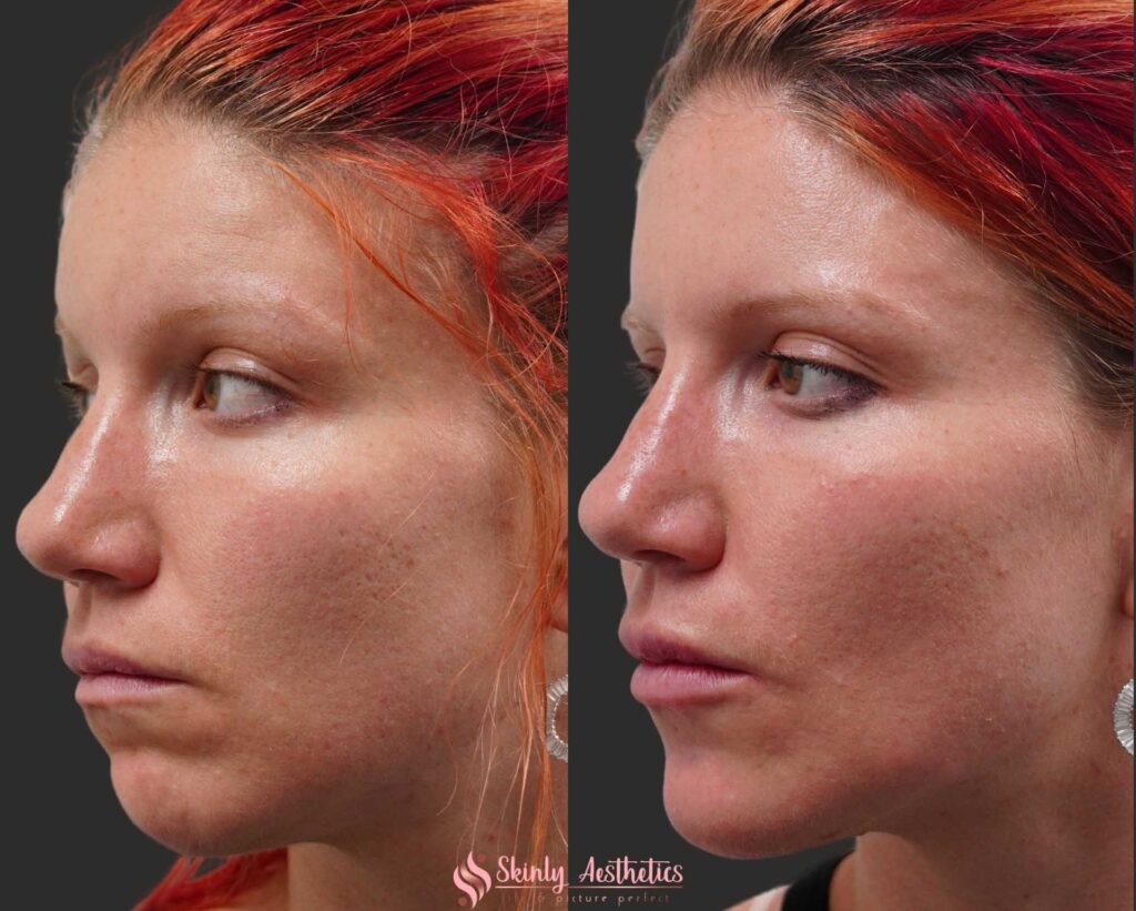 Juvederm dermal filler chin enhancement before and after