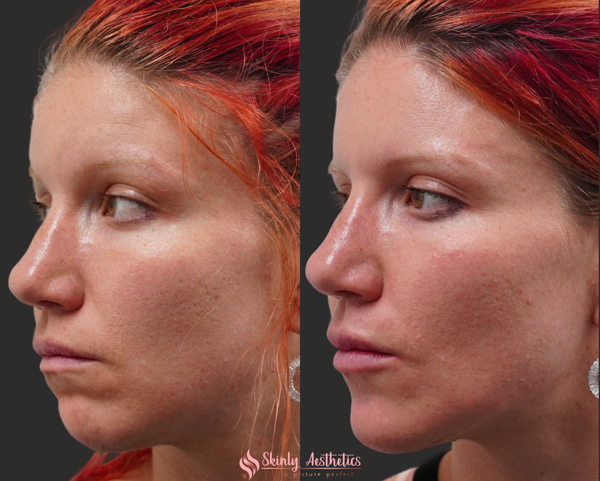 Juvederm dermal filler chin augmentation before and after results