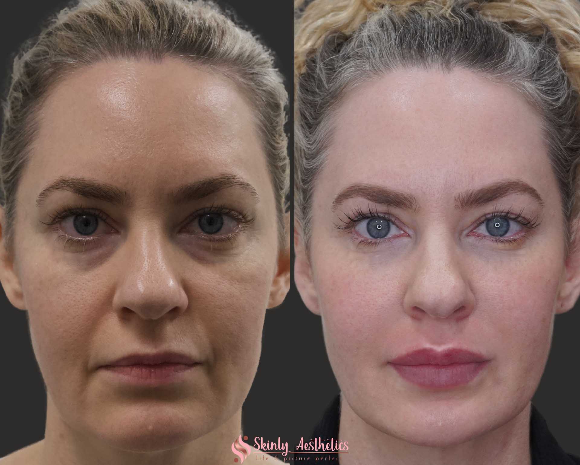 before and after results following Juvederm dermal filler injections for under eye circles