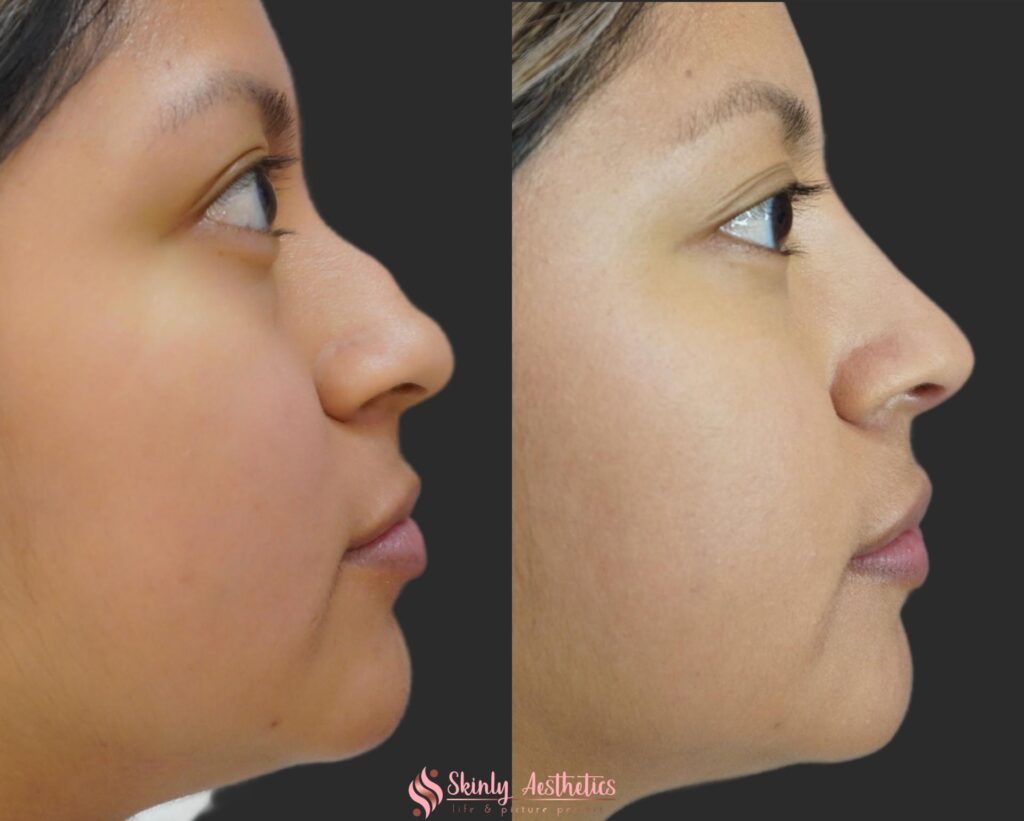 before and after results following non-surgical liquid nose job for nose straightening
