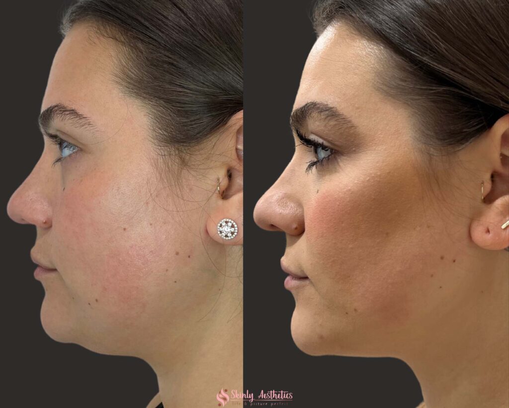 before and after Kybella and CoolSculpting Mini treatments for double chin fat