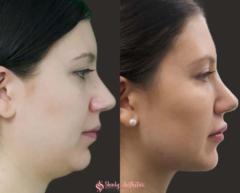before and after results following double chin removal with Kybella injections and CoolSculpting fat freezing