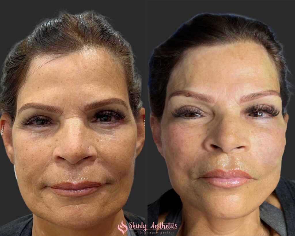 before and after results PDO face thread lift for sagging cheeks and jowls