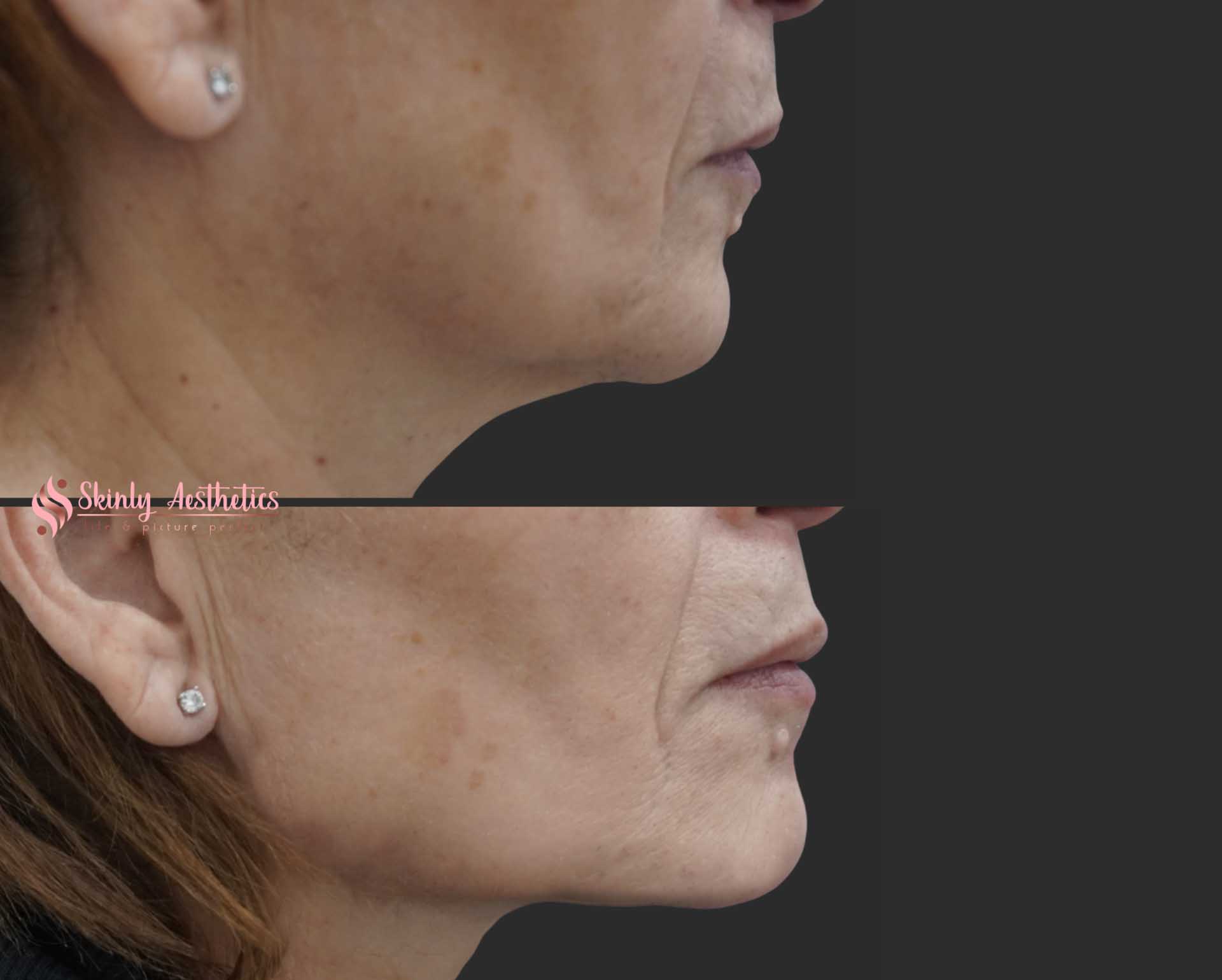 before and after results of PDO thread neck lift procedure