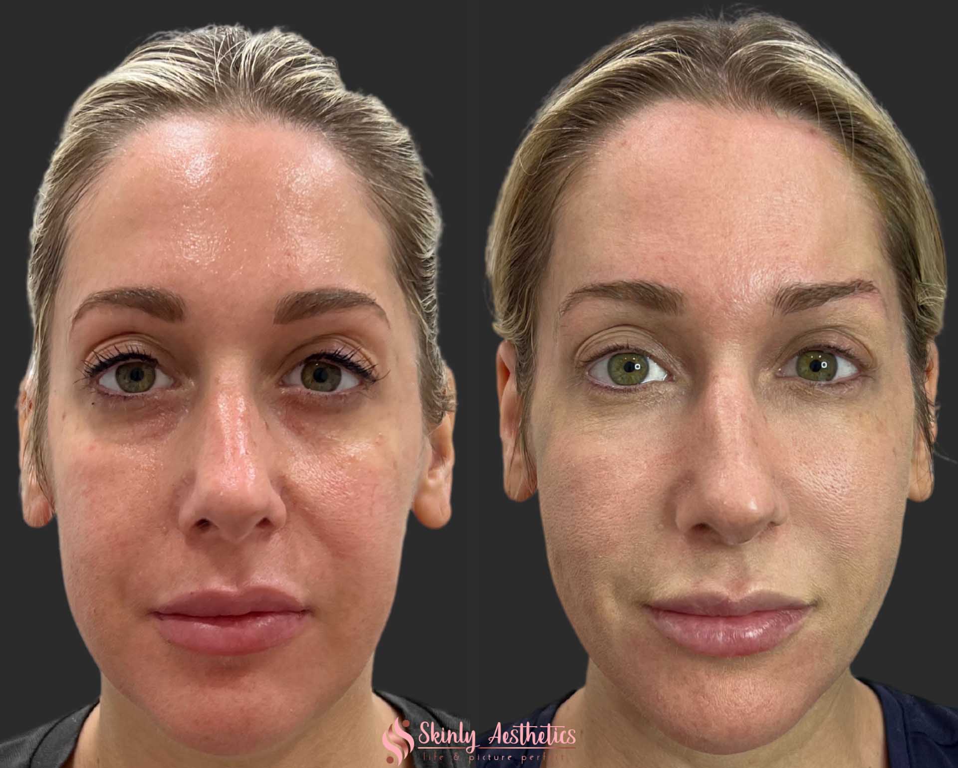 results after PDO thread facelift to lift saggy cheeks and jowls