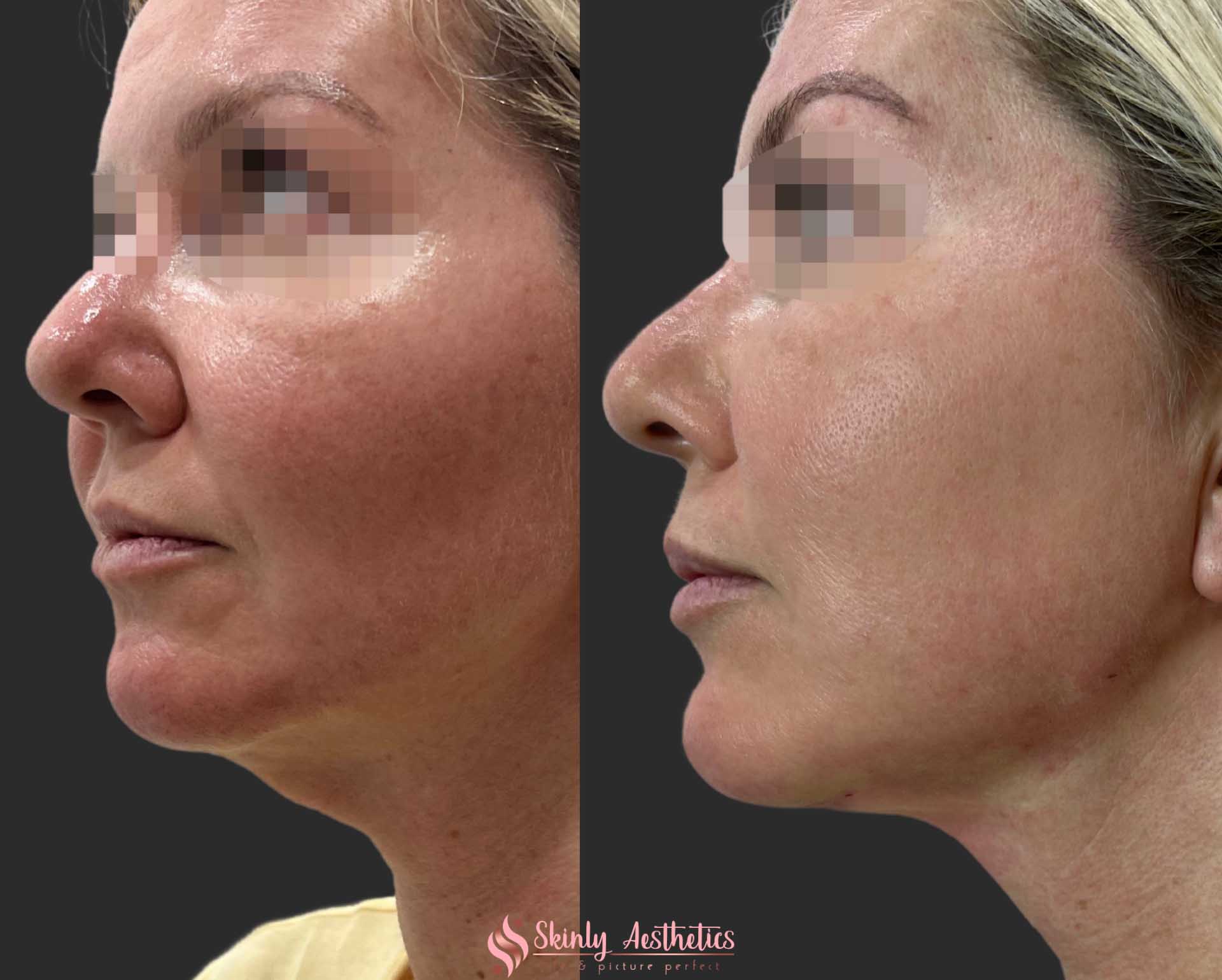 results after getting PDO thread neck lift to tighten turkey neck