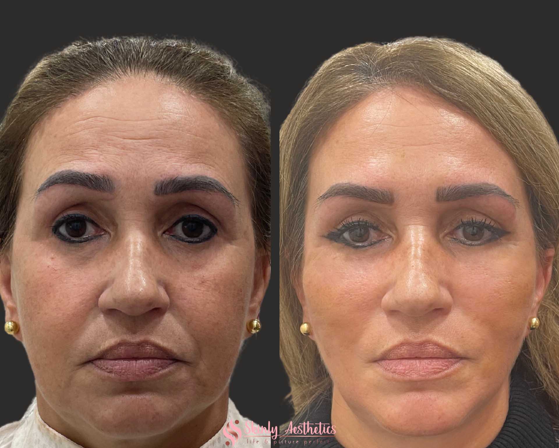 before and after results following V-shaped facelift with PDO threads