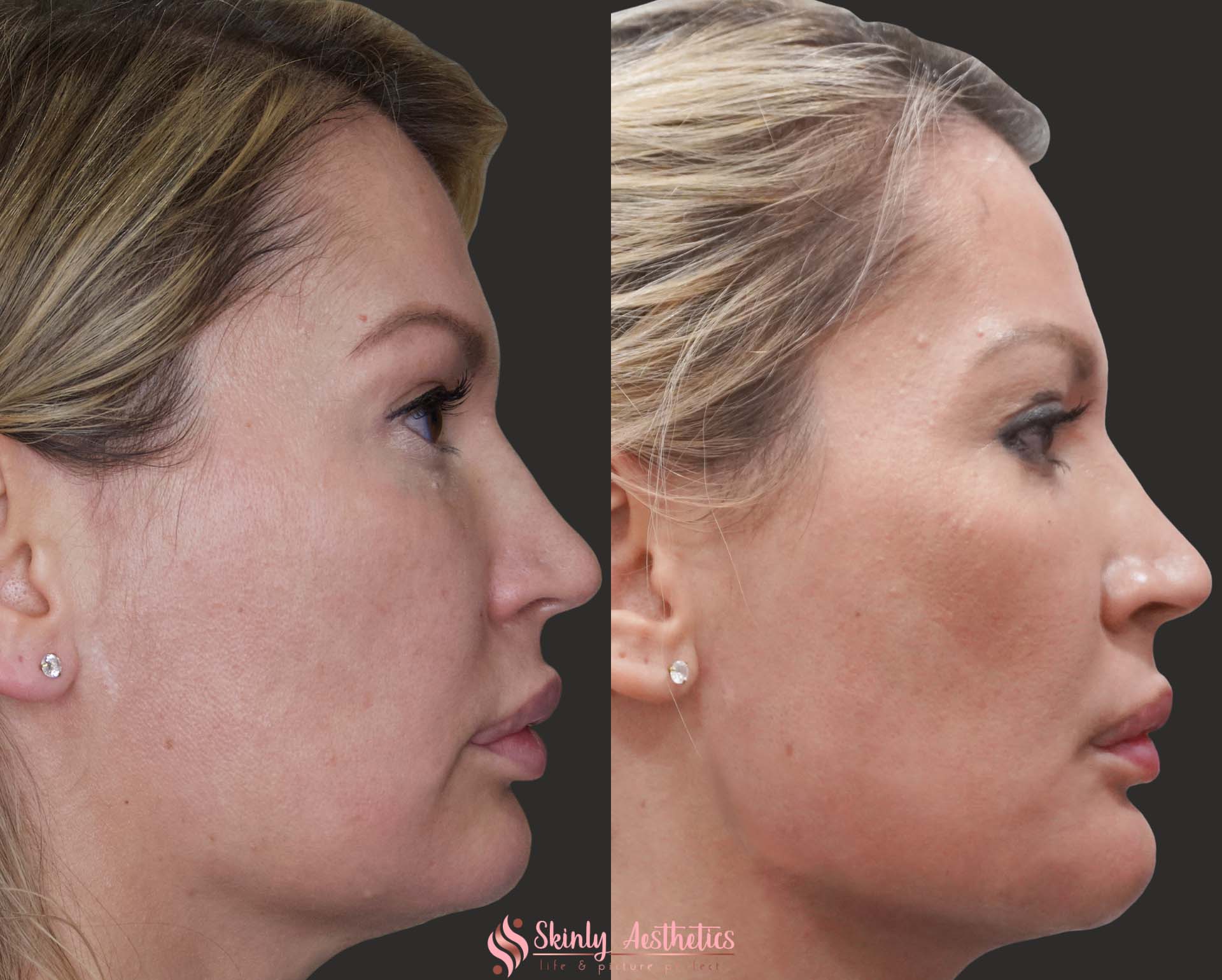 Before and after results following jawline sculpting with Radiesse filler