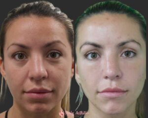 before and after results following Restylane dermal filler injection for the under-eye hollowness