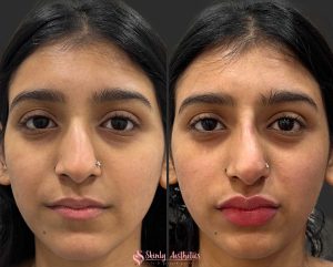 Russian doll style lip injection technique