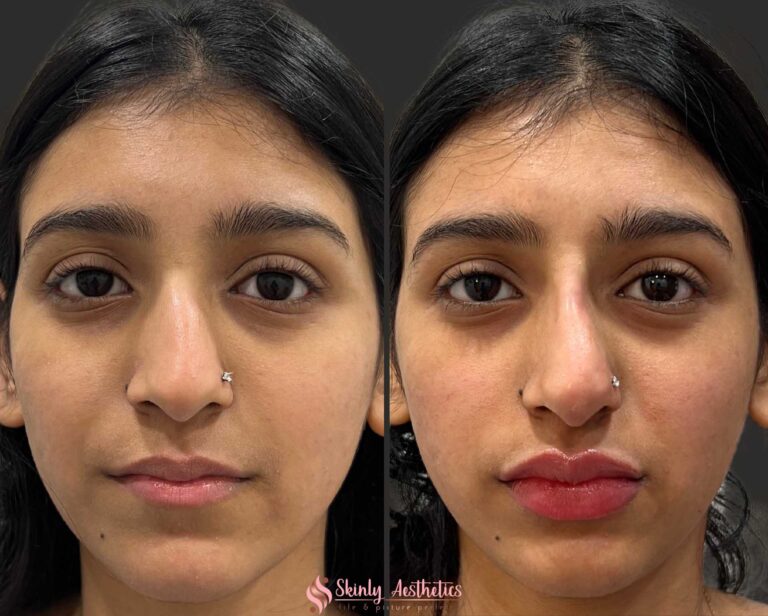 before and after results following Russian doll style lip filler injections