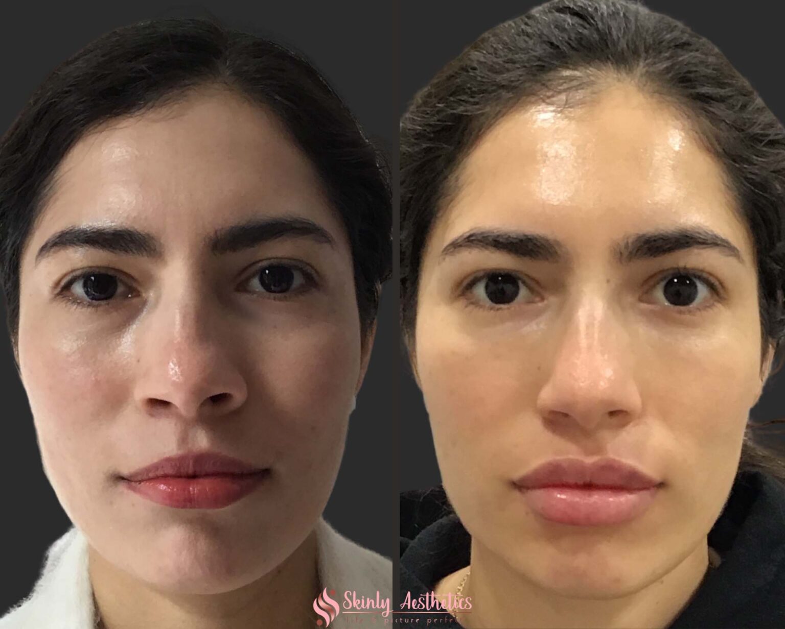 Juvederm Fillers Benefits, Costs, Results & Procedure Steps