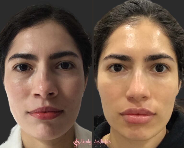 Russian lip filler augmentation technique before and after results with Juvederm dermal filler