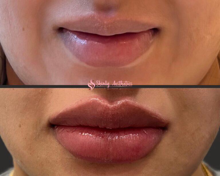 Russian technique lip filler augmentation results with Juvederm filler