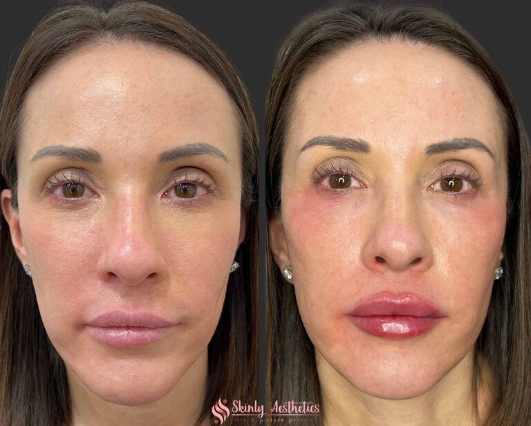 Russian lip filler technique before and after results