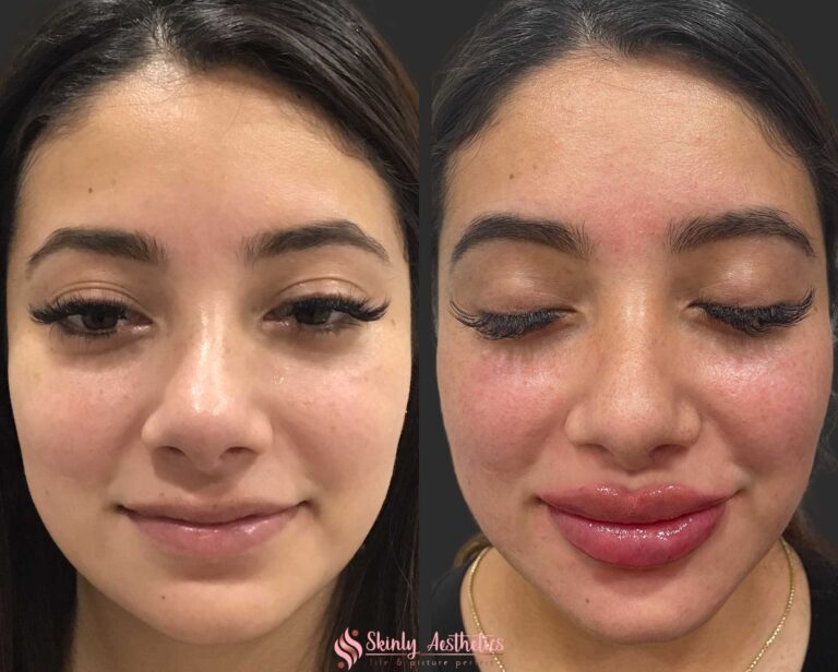 before and after results following Russian lip technique augmentation with Juvederm Ultra